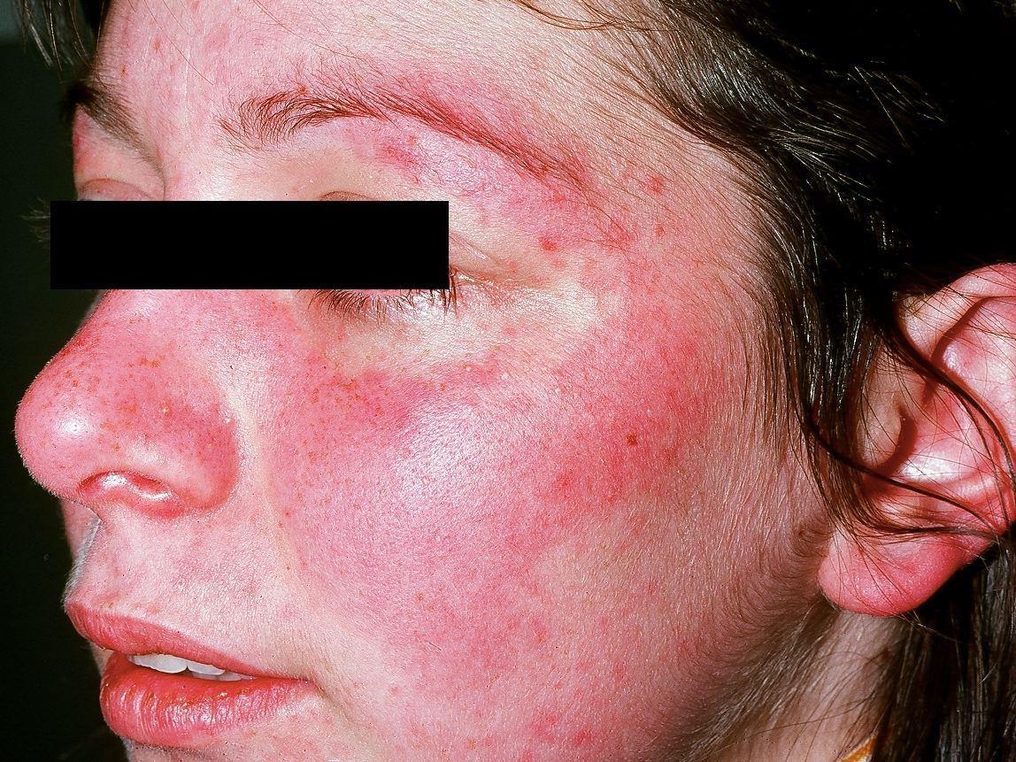 best of Facial rashes Recurring