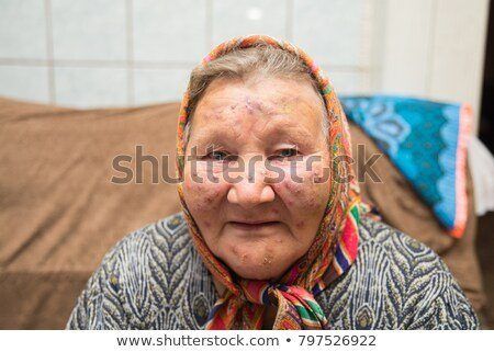 best of Facial breakout citizen pimples Senior