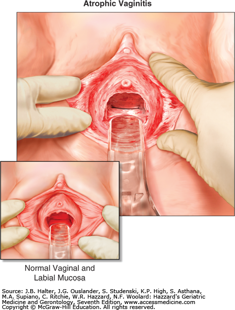 best of Labia atrophy Vulva